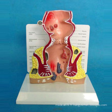 Modèle de démonstration anatomique médicale du Rectum humain pour l&#39;enseignement (R100209)